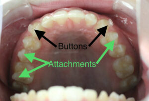 invisalign button rubber bands